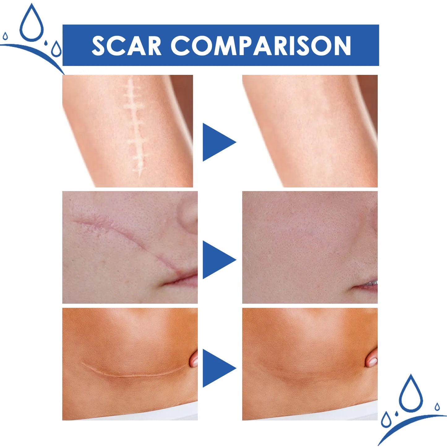Scar Repair Cream: Visibly Softens Fast