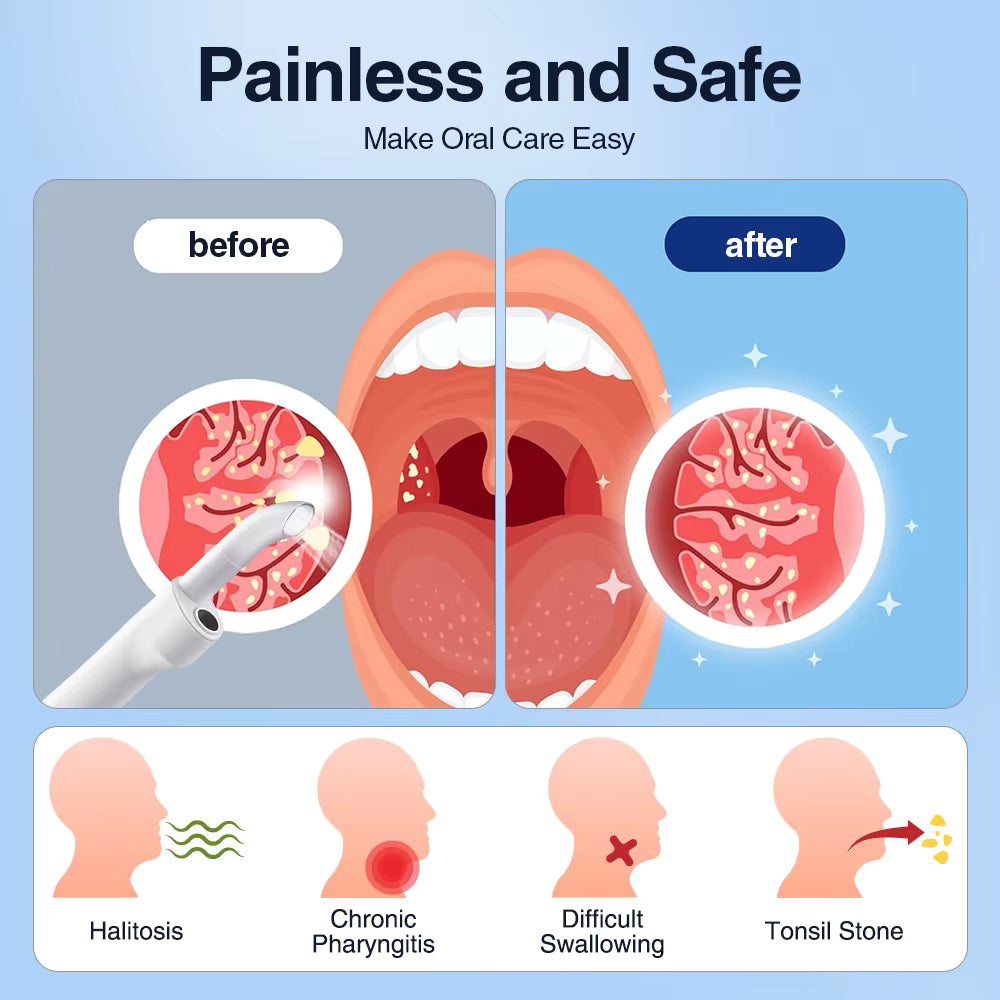 Electric Tonsil Stone Remover: Painless HD View